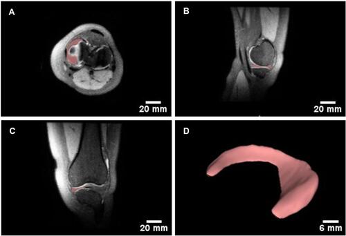 Figure 6 Design of patient-specific 3D digital model of the human knee meniscus. Illustration of medial meniscus segmentation from MRI images of the 3 distinct planes (A) axial plane; (B) Sagittal plane; and (C) Coronal plane) the right knee of a subject. (D) The reconstructed 3D digital model of the medial meniscus.