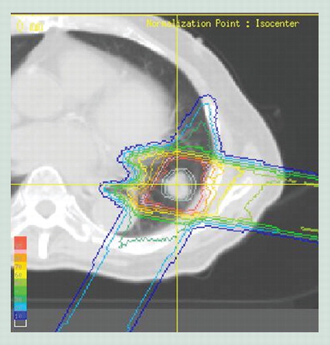 Figure 2. Dose distribution of proton beam therapy for stage I non-small-cell lung cancer.Because of the low lung density, the doses do not fall off sharply at the target depth. Also, the edge at the end of the beam range is irregular, because the scapula and ribs are in the pathway. The beam range of the part that passes through bones is smaller than that of the part of the beam that avoids bone.