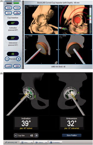 Figure 3. Screen shots of (A) CT-based navigation and (B) image-free navigation at the time of cup placement.