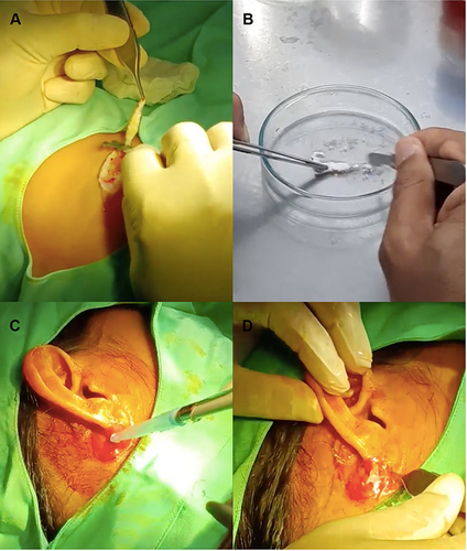 Figure 1 Autologous non-cultured cell spray (ANCC) method. (A) Donor site preparation on the left thigh by shave excision, (B) scrapping of the skin tissue to release cells, (C) spraying of cells to the recipient site, and (D) covering of the grafted area with punched plastic wrap.