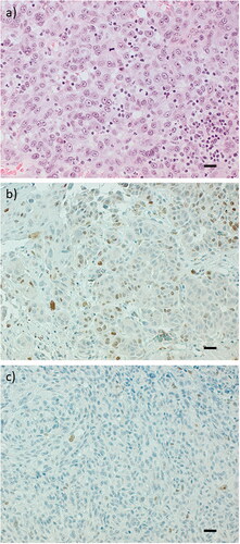 Figure 1. Representative hematoxylin-eosin slides of primary ulcerated CMMs demonstrating presence of TILs (a) and representative expression of protein Ki67 with immunohistochemistry demonstrating high proportion (b) and low proportion (c). Twenty-seven percent (10/37) of the recurrence-free patients and 61% (20/33) of the patients with a recurrence had primary tumours with high Ki67 staining (cut-off level 10%). Scale bar = 50 µm.