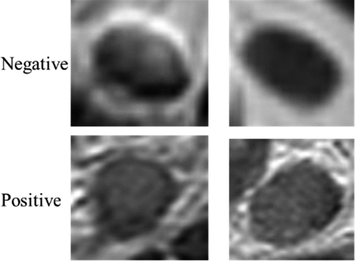 Figure 1. CRC LN. The top row are negative, the bottom row is positive