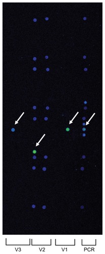 Figure 4 Results of the hybridization assay for polymerase chain reaction (PCR) amplifications from vitreous sample of case 2. PCR products are spotted as a reference in the right side. Green or blue (arrow) circles in V1, V2, and V3 represent strong hybridization. Fungal identification is determined by the combination of strong hybridization in V1, V2, and V3. This case shows a pattern of Candida parapsilosis.
