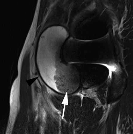 Figure 2. Moderate adverse reaction to metal debris. A sagittal T2W MR positioned just medial to the acetabular cup demonstrates moderate periprosthetic disease with a large cystic collection, demarcated by a low signal wall (black arrow), and filled with debris (white arrow) extending proximally in the line of the iliopsoas bursa. The relatively thick low signal wall and the debris are not typical of conventional iliopsoas bursae.