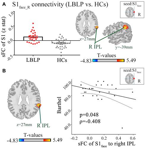 Figure 4 (A) Patients with LBLP exhibited increased sFC to the right IPL. Values are the mean ± SEM (two-sample t-test, two-tailed, voxel-level P < 0.001, GRF correction, cluster-level P < 0.005). (B) Partial correlational analysis between sFC alterations and the Barthel index in LBLP patients.Abbreviations: sFC, static functional connectivity; LBLP, low-back-related leg pain; IPL, inferior parietal lobule; S1face_R, representation of the right face in the primary somatosensory cortex.