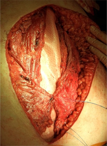 Figure 1 Retrorectus placement of porcine dermal mesh (Permacol™; Covidien, New Haven, CT, USA) in abdominal wall reconstruction for recurrent incisional hernia repair.