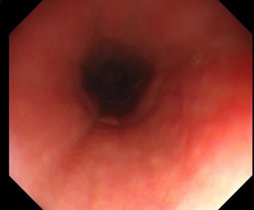 Figure 3 Electronic gastroduodenoscopy showing no significant stenosis in the duodenum.