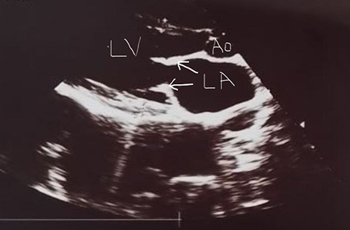 Figure 1 Transthoracic echocardiography from a patient with rheumatic valvular heart disease and recurrent Sydenham chorea in parasternal long axis view. Mitral valve leaflets are thickened (arrows).