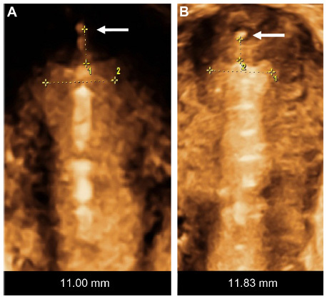 Figure 1 The fundal transverse diameter of uterine cavities is often very narrow, even less than 20 mm (A and B).