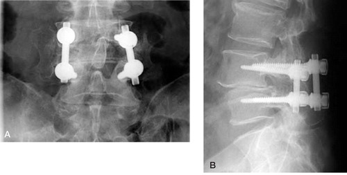 Figure 6:1 Instrumented fusion L4–L5 with bridging trabecular bone between transverse processes lateral to Diapason implants. A. Anteroposterior view. B. Lateral vew.