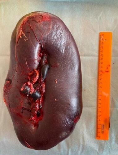 Figure 1 Removed spleen with thin capsule showing threat of rupture.