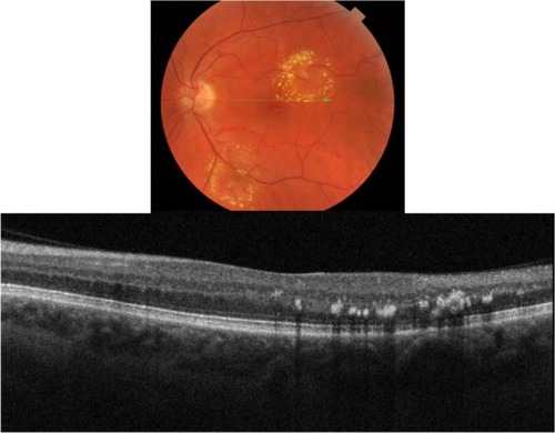 Figure 4 Fundus photograph (top) showing a circinate ring of exudates in the left eye of a patient with macroaneurysm; the B-scan line on the fundus photograph has the same width as the B-scan SD-OCT image (bottom); SD-OCT image demonstrates exudate deposits at the level of outer plexiform layer (OPL).