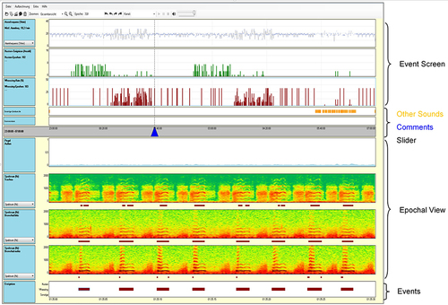 Figure 2 The user interface of the LEOSound-Analyzer is divided into two major fields - shown as Event Screen and Epochal View. The Event Screen displays the breathing rate (blue line), the detected coughing events (shown in green) and the wheezing rate of the associated epoch (shown in red). In the Epochal View the selected epochs in this example. The Event Screen is displayed as a spectrogram. Optionally, the epochs can also be represented as a loudness level.