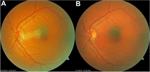 Figure 1 (A) shows acute cilioretinal artery occlusion after 24 hours following cardiac catheterization. (B) shows resolution of the retinal edema, and residual retinal exudates, 14 weeks later.
