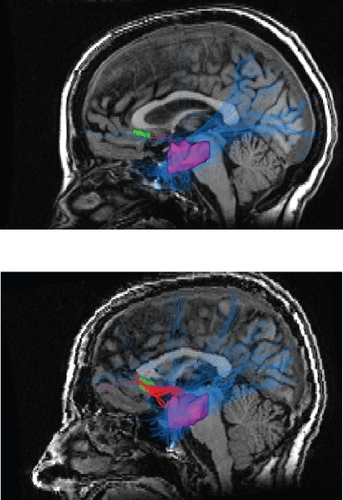 Figure 1 In the top picture is the diffusion tensor imaging tractography output for a healthy control. In the bottom picture is a representative tractography output from a bipolar disorder patient. All patients were on lithium monotherapy or combined therapy consisting of lithium, atypical neuroleptics and selective serotonin reuptake inhibitors. The bipolar disorder sample consisted of 8 males and 8 females with a mean age of 41 years. Note the much greater density and thickness of the red colored fibers in the bipolar disorder subjects in the bottom picture. The red tortuous pathway consists of reconstructed fibers connecting the left subgenual cingulate which is depicted in green and the left amygdalo-hippocampal complex depicted in purple. The blue lines represent reconstructed fibers connecting the left amygdalo-hippocampal complex to the rest of the brain. Copyright © 2007, Nature Publishing Group. Reproduced with permission from CitationHouenou J, Wessa M, Douaud G, et al. 2007. Increased white matter connectivity in euthymic bipolar patients: Diffusion tensor tractography between the subgenual cingulate and the amygdalo-hippocampal complex. Mol Psychiatry, 12:1001–10.