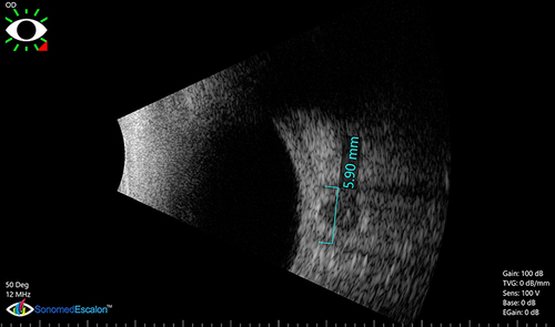 Figure 1 The ONSD of the right eye on admission (before surgical intervention) (5.89 mm).