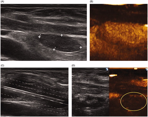Figure 1. Single-fiber laser ablation for primary hyperparathyroidism. (A) A 69-year-old female presented with severe osteoporosis, nephrocalcinosis and elevated parathormone levels. A 1.6 × 0.6 cm adenoma was identified behind the lower pole of the thyroid. (B) Contrast enhanced ultrasound confirms marked homogeneous vascularity. (C) Gray scale ultrasonography demonstrates insertion of a single fiber (central white line) along the longitudinal axis of the gland. Normalization of parathormone was noted at 6 months. (D) Two-year follow-up shows a marked reduction in the gland size (0.7 × 0.4 cm) with elimination of vascularity at contrast enhanced ultrasound (yellow circle).