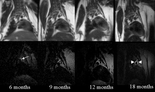 Figure 1. HASTE (upper row) and IR‐turboFLASH images (lower row) at identical slice position in a WHHL rabbit. At the age of 6 months only a small area of enhancement can be detected. The area of enhancement grows continuously over time and at the age of 18 months the aortic wall shows a circumferential enhancement.