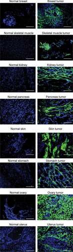 Figure 3. Microscopic fluorescence analysis of TNC-D expression of frozen tumor and normal tissues