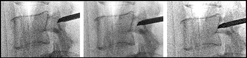 Figure 8 Lateral view showing progression of the trocar towards the posterior aspect of the lumbar vertebral body while simultaneously advancing the trocar from the lateral to medial pedicle border.