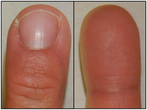 Figure 6. Appearance 6 months after surgery. No recurrence of lesions was noted, and finger morphology and nail shift improved.