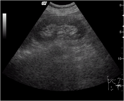 Figure 2b. Renal echo showed no obstructive uropathy of left kidney one month postoperation.