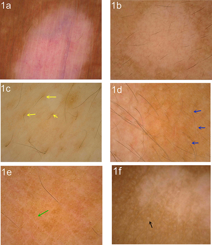 Figure 1 Dermoscopic features of patients with vitiligo. (a) Absent pigment network and sharp border (polarized light ×20); (b) faint pigment network (polarized light ×20); (c) perifollicular hyperpigmentation (yellow arrow, polarized light ×50); (d) perifollicular depigmentation (blue arrow, polarized light ×50); (e) micro-Koebner phenomenon (green arrow, polarized light ×20); (f) satellite phenomenon (black arrow, polarized light ×20).