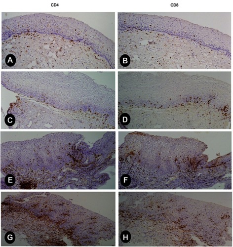 Figure 1 Representative images of IHC staining showing low CD4+ILs and CD8+ILs (score 1) in serial sections of HPV- normal cervix (A, B); low CD4+ILs and CD8+ILs (score 1) in serial sections of HPV+ normal cervix showing CD8+ lymphocytes predominantly in epithelial layer (C, D); CD4+TILs and CD8+TILs (score 2) in serial sections of HPV+ low grade CIN, higher than in former cases, showing predominance of CD4 lymphocytes (E, F); high CD4+TILs and CD8+TILs (score 3) in high grade CIN, showing predominance of CD4 lymphocytes (G, H).Abbreviations: IHC, immunohistochemistry; ILs, infiltrating lymphocytes; TILs, tumor infiltrating lymphocytes; CIN, cervical intraepithelial neoplasia.