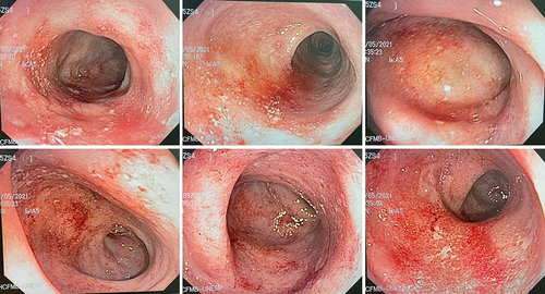 Figure 2 Colonoscopy images showing enanthema, friability, and fibrin-covered erosions throughout the colon, consistent with colitis in moderate activity, which is representative of endoscopic Mayo score 2.