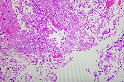 Figure 7 The pathological specimen confirmed chorionic villi (CV) within the ectopic pregnancy mass (haematoxylin and eosin stain, 200×magnification).