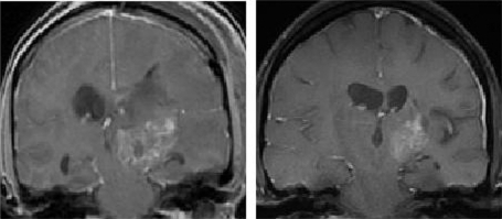 Figure 2 MRI scans showing a typical prolonged response to single-agent erlotinib in a patient with progressive GBM. The image in the left panel is consistent with a partially necrotic enhancing mass and surrounding peri-tumoral edema. The image on the right, obtained 16 months after the initiation of erlotinib, reveals a decrease in the mass and associated edema. The patient was on high-dose dexamethasone treatment (to control cerebral edema) at the time of erlotinib treatment initiation and was off all dexamethasone at the time of the follow-up scan.