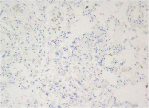 Figure 5 PD-L1 staining of the lung tumor. The tumor cells were weakly stained by the anti-PD-L1 antibody clone 22C3 with a low expression level (TPS was slightly over 1%).