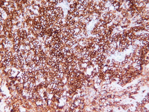 Figure 2.  CD20 immunostain demonstrates the neoplastic infiltrate to be B-cells (original magnification×400).