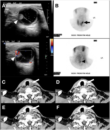 Figure 3. (A) Ultrasound of the thyroid demonstrates a 3.1 cm complex cyst centred on the left lobe of the thyroid, with a moderately thick wall, central cystic components and a hypervascular mural nodule protruding intraluminally (white arrowhead). (B) Technetium-99m sestamibi early and delayed images demonstrate focal uptake corresponding to the hypervascular nodule identified on US in the left lobe of the thyroid gland (black arrow). There is retention of radiotracer uptake on delayed images within the nodule (black arrowhead) with washout of the background thyroid activity. (C-F) Multiphasic CT images of the neck with initial non-contrast phase followed by 30, 60 and 90 second post-contrast delays, demonstrate a 3.3cm mixed solid-cystic lesion posterior to the left lobe of the thyroid gland, containing a solid nodule which demonstrates hyperenhancement and washout (white arrow), with Hounsfield Units of 36, 131, 104 and 97 respectively.