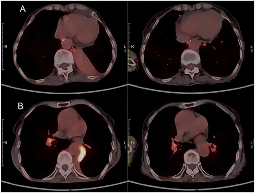 Figure 4 (A) This image shows the most severely compressed region of the lungs, with the left side depicting the PET/CT results obtained on December 23, 2021, and the right side displaying the PET/CT results obtained on June 9, 2023. (B) This image shows the area of highest metabolic activity in the lung lesions, with the left side showing the PET/CT results from December 23, 2021, and the right side showing the PET/CT results from June 9, 2023.