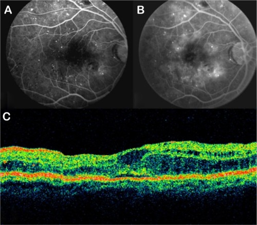 Figure 23 (A and B) Fluorescein angiography shows diffused diabetic macular edema. (C) Stratus optical coherence tomography illustrates diffuse retinal thickening and cystic spaces, consistent with cystoid macular edema.