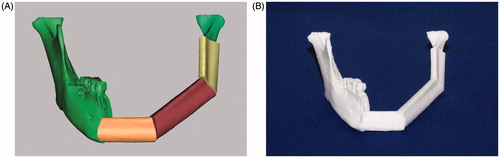 Figure 2. Mandibular reconstruction simulation and 3-D printed model. (A) The mandible was reconstructed with 3D imaging; the mandible was cut from the left subcondylar neck region to the right first premolar anterior region. Three-dimensional simulation of the mandible reconstruction with the fibula bony segments required bending the fibula at the canine area and at the angle area. This required three separate fibula segments: the anterior (light orange), the middle (brown), and the posterior (yellow) segments. (B) The reconstructed mandibular model was produced with a 3D printer, based on data from the simulated mandibular reconstruction with the fibula.