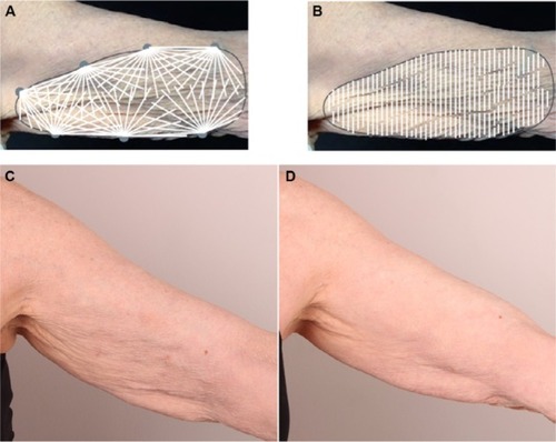 Figure 4 Upper arm injection techniques with diluted calcium hydroxylapatite for skin tightening. (A) Crosshatching technique with retrograde linear-threads performed with a 5 cm-long 25G cannula. (B) Vertical retrograde linear threading technique performed with a 28G needle. (C) Before and (D) after treatment with CaHA for the upper arms (Courtesy of Dr Jani van Loghem).