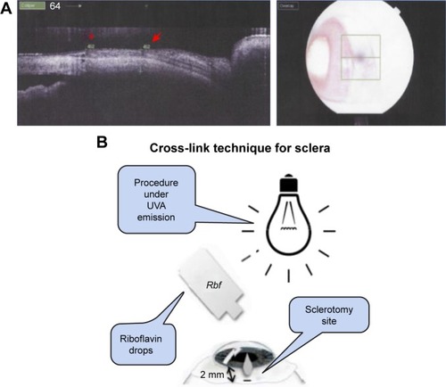 Figure 1 (A) Anterior OCT: rabbit scleral thickness at the sclerotomy site (red arrow) and scleral thickness at a control site (red asterisk). The image on the right shows the place on the sclera where the OCT scan was made. (B) Schematic representation of CXL procedure details.