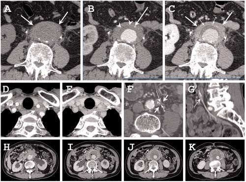 Figure 1. Radiographic findings. (a–c) Seventy-three-year-old man with IgG4-related periaortitis. (a) Precontrast CT shows the soft tissue density mass around the abdominal aorta (white arrows). (b) The arterial phase of dynamic contrast-enhanced CT shows the inferior mesenteric artery in the soft tissue density mass (thin arrow). The atherosclerotic plaque is not enhanced (arrowheads). (c) The delayed phase of dynamic contrast-enhanced CT shows that the periaortic mass is slightly enhanced (arrows). A high density thin layer is seen between the atherosclerotic plaque and the periaortic mass (small arrows). (d,e) A 68-year-old man with IgG4-related periarteritis. (d) The arterial phase of dynamic contrast-enhanced CT shows a soft tissue density mass around the left common carotid artery (arrows). (e) The delayed phase of dynamic contrast-enhanced CT shows that the mass is slightly enhanced (arrows). Stenosis of the left common carotid artery is not seen in this case. (f,g) A 63-year-old man with IgG4-related periarteritis. (f) The arterial phase of dynamic contrast-enhanced CT shows a soft tissue density mass around the inferior mesenteric artery (arrows) with a luminal stenosis (thin arrow) and calcification (small arrow). (g) In the reconstructed sagittal image, the luminal stenosis can be clearly seen (thin arrow). (h–i) IgG4-related abdominal inflammatory aneurysm treated by stent graft implantation.