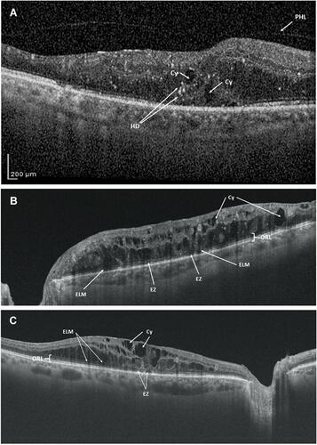 Figure 2 Spectral domain optical coherence tomography images. (A) Disorganization of the retinal inner layers (DRIL). It is not easy to identify the boundaries of the inner layers (white dotted line). Additionally, it is possible to see cysts (Cy) and hyperreflective dots (HD) in the outer layers, as well as the posterior hyaloid (PHL). (B) Spongiform edema with damage in the outer (ORL) and inner (INL) retinal layers. Besides the presence of cysts (Cy), it is possible to identify the external limiting membrane (ELM), and ellipsoid zone (EZ) disruptions. (C) Cystoid macular edema with external limiting membrane disruptions (ELMD). Additionally, it is possible to see some damage in the ellipsoid zone (EZ) and some cysts (Cy).