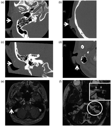 Figure 3. Preoperative images. (a, b, c, d) In CT, a 2 cm tumor on the anterior wall of the right external auditory canal with the destruction of the bones of the anterior and inferior walls was found. Also, multiple masses were observed behind the right ear. (e, f) In contrast-enhanced MRI, a tumorous lesion with a diameter of 19 mm in the right external ear canal, as well as multiple well-defined masses above, behind, and below the right auricle were found. Also, a suspected small vestibular schwannoma localized in the left internal ear canal was observed.