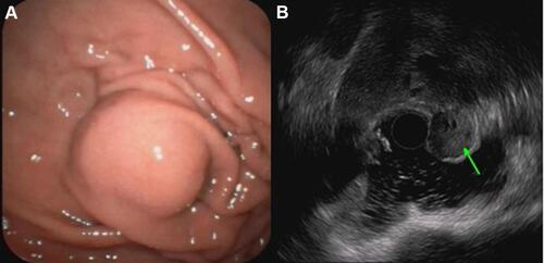 Figure 1 Endoscopic and endoscopic ultrasonography for gastrointestinal stromal tumor. (A) A submucosal tumor was detected in the gastric fundus by general gastroscopy. (B) Endoscopic ultrasonography showed that the lesion originated from the muscularis propria, was hypoechoic, and had a non-homogeneous echo and visible echo-free area; Doppler ultrasound did not identify blood flow; cross-section size: 2.0 cm * 2.5 cm.