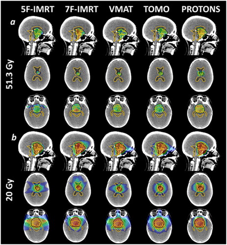 Figure 1. Dose distribution for one example patient (Case 3), illustrating the five different techniques. Black line: planning target volume (PTV); light orange line: whole ventricular system. (1a) dose colour wash at 95% target coverage isodose (51.3 Gy); (1b) dose colour wash at 20 Gy.