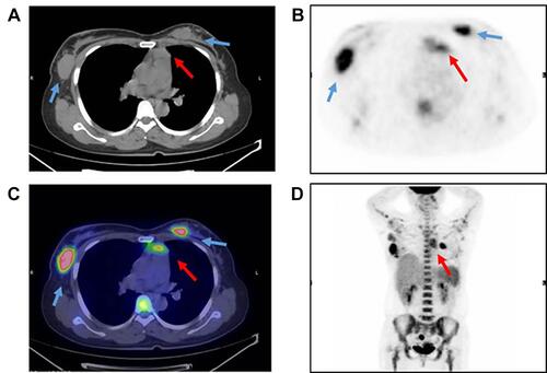 Figure 3 Imaging by PET-CT scan.