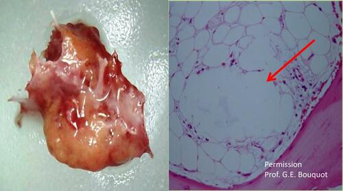 Figure 6 Left picture: Preparation of intraoperatively removed fatty-degenerative osteonecrosis from BMD/AIOJ/FDOJ; Right picture: Necrotic adipocytes confluent to so-called “oil cysts” with high-fat content (arrow points to such a big “oil cyst”).