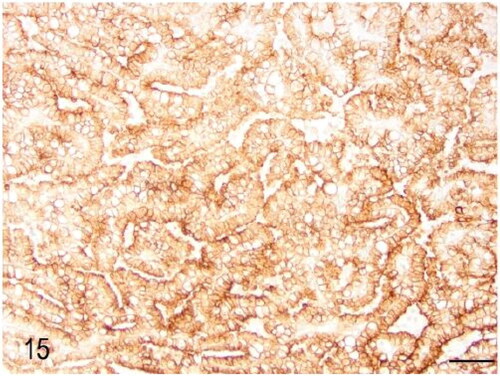 Figure 15. Case 3. The pulmonary adenoma was diffusely positive for multicytokeratin immunohistochemistry. Bar = 50 µm.