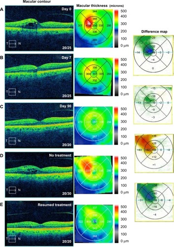 Figure 6 Optical coherence tomography studies for case 6 (branch retinal vein occlusion).