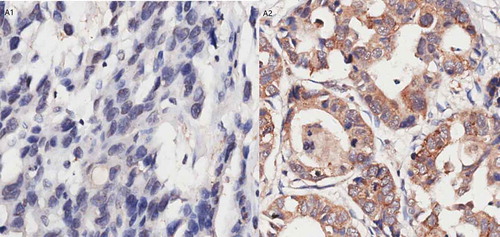 Figure 2. Immunohistochemistry results of VEGFR-2.A1. Negative expression of VEGFR-2 in gastric cancer tissue. A2. Positive expression of VEGFR-2 in gastric cancer tissue.