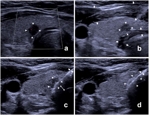 Figure 2. Ultrasound (US) images of the ablation procedure performed on a 31-year-old female with papillary thyroid carcinoma adjacent to the trachea. (a) US image displaying the tumor (arrowheads) before ablation; (b) the hydrodissection technique (arrows) was applied wherein normal saline was injected into the space between the tumor (arrowheads) and the trachea as well as the space between the anterior thyroid capsule and superficial soft tissue; (c) the ablation needle (arrows) was inserted into the target tumor using the trans-isthmic approach; the ablation was initiated from the deepest portion of the tumor and the portion closest to the trachea. The tumor was elevated away from the trachea using the operator’s finger as the fulcrum (utilizing the leverage pry-off method) to further increase the distance (double side arrow) between the tumor and the trachea during ablation; (d) the ablation needle (arrows) was moved toward to the superficial portion of the tumor (arrowheads).